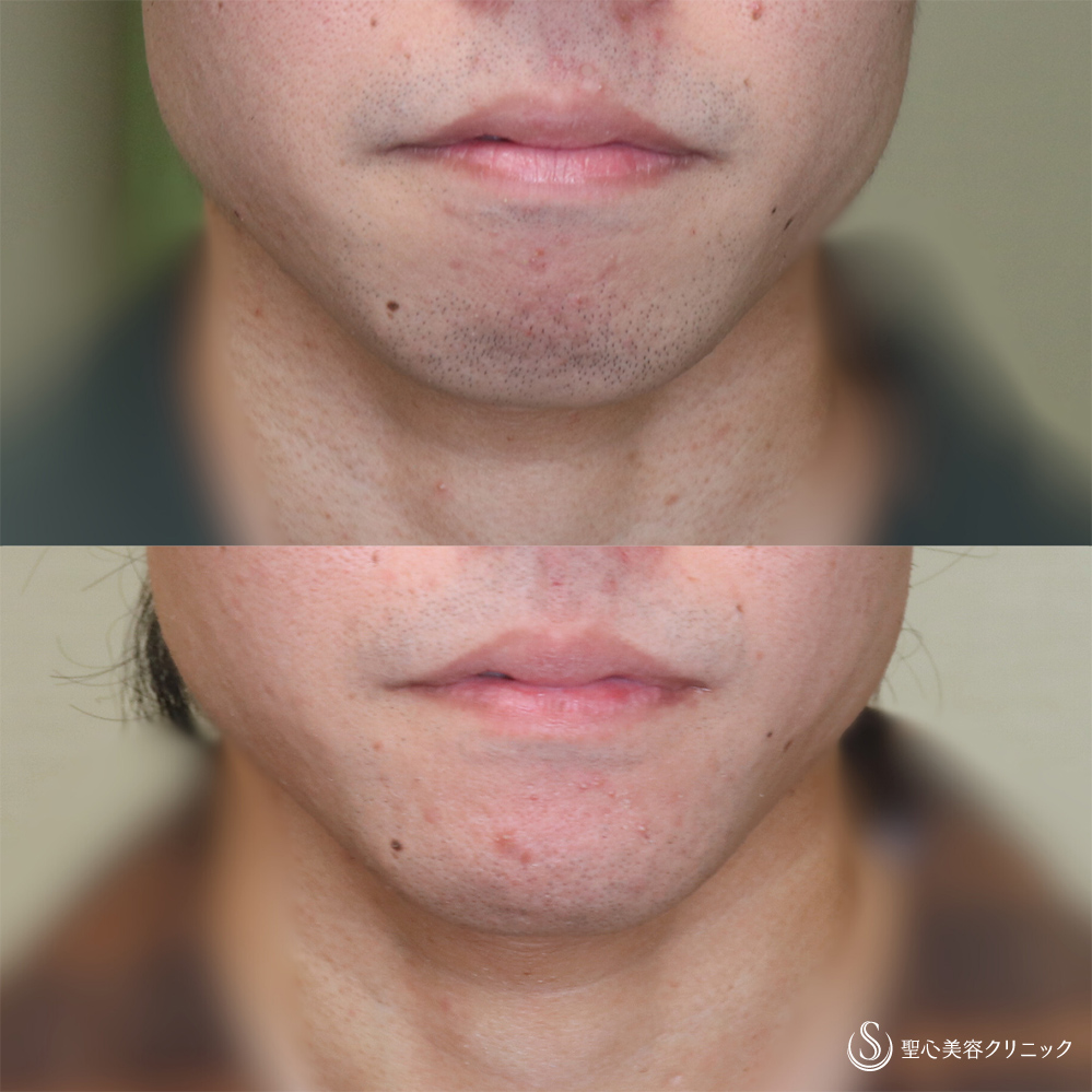 【20代男性・Eラインを整える】あごプロテーゼ（術後3ヶ月） After 