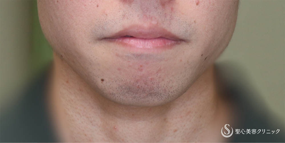 【20代男性・Eラインを整える】あごプロテーゼ（術後3ヶ月） Before 