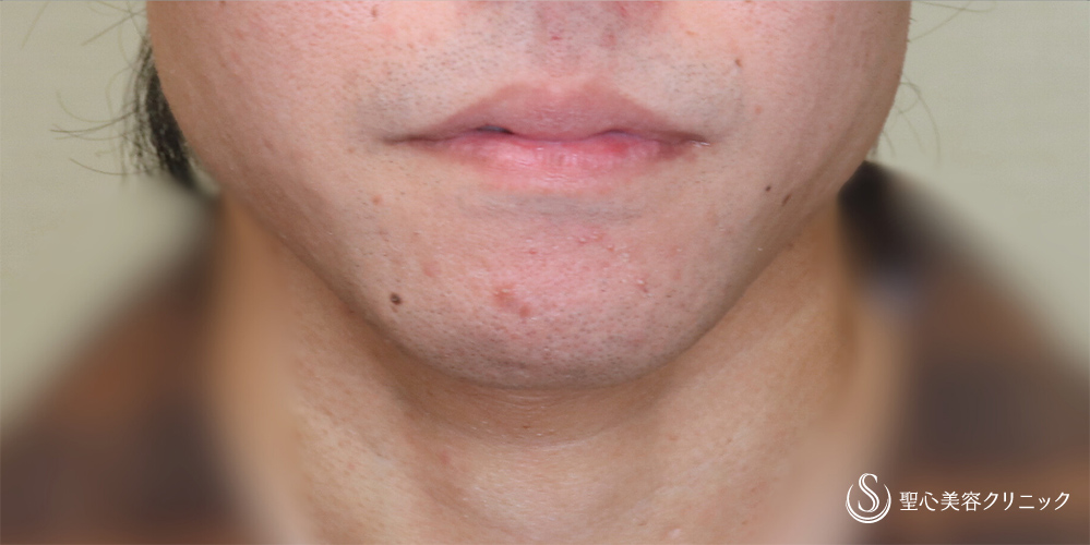 【20代男性・Eラインを整える】あごプロテーゼ（術後3ヶ月） After 