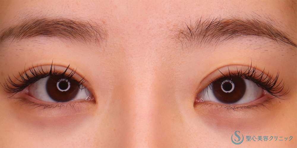 【20代女性・寄り目にさせず目頭側まで二重を入れたい！！平行に近い二重にしたい！！】目上切開（術後2ヶ月） After 