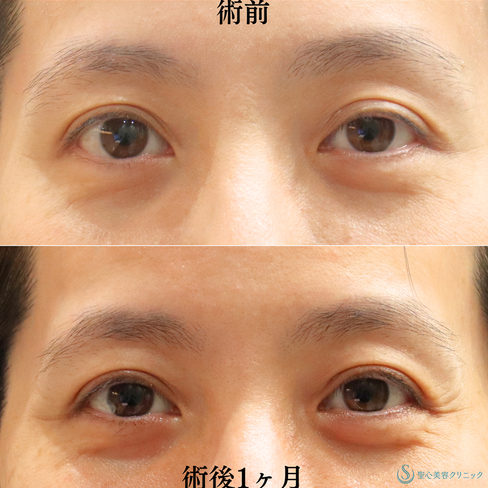 【40代女性・眼瞼下垂手術により目の開きを改善】眼瞼下垂（埋没法）（術後1ヶ月） Before 