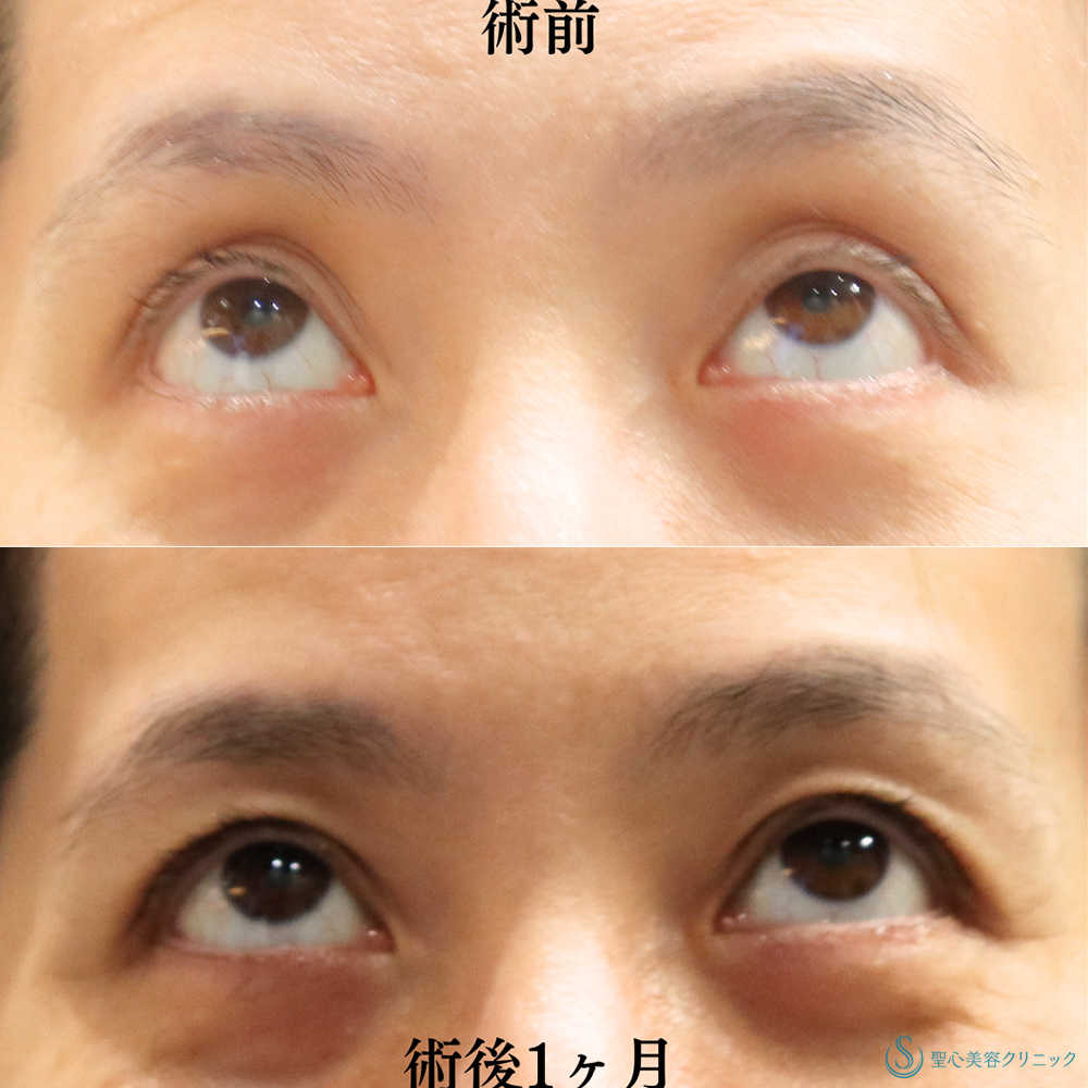 【40代女性・眼瞼下垂手術により目の開きを改善】眼瞼下垂（埋没法）（術後1ヶ月） After 