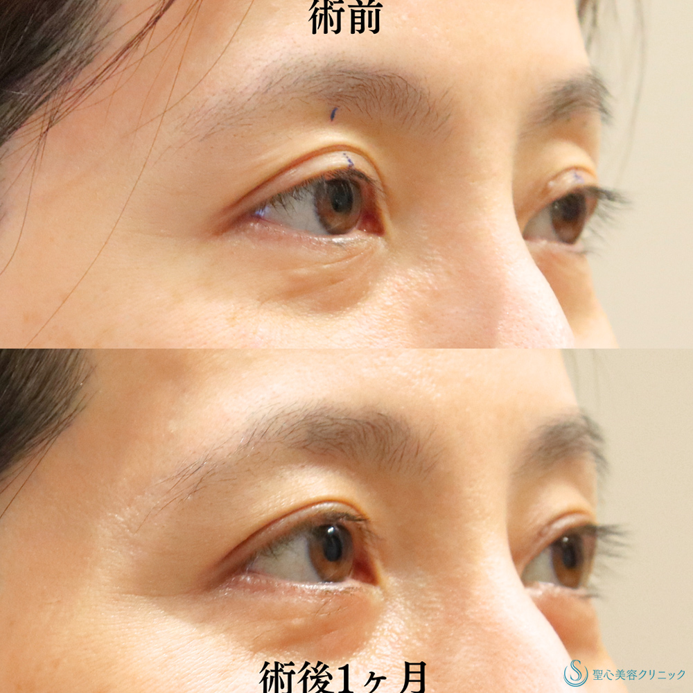 【40代女性・眼瞼下垂手術により目の開きを改善】眼瞼下垂（埋没法）（術後1ヶ月） After 