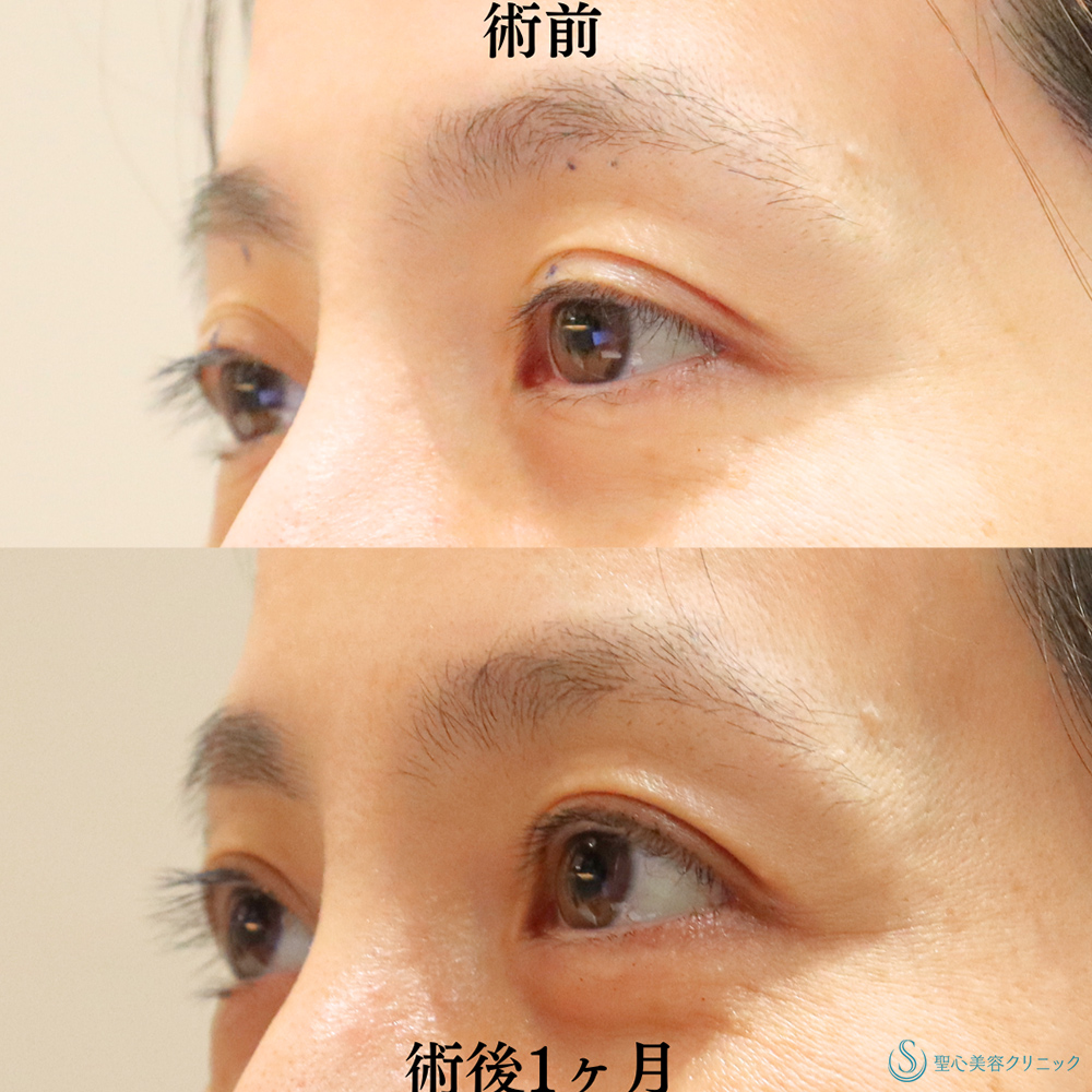 【40代女性・眼瞼下垂手術により目の開きを改善】眼瞼下垂（埋没法）（術後1ヶ月） After 