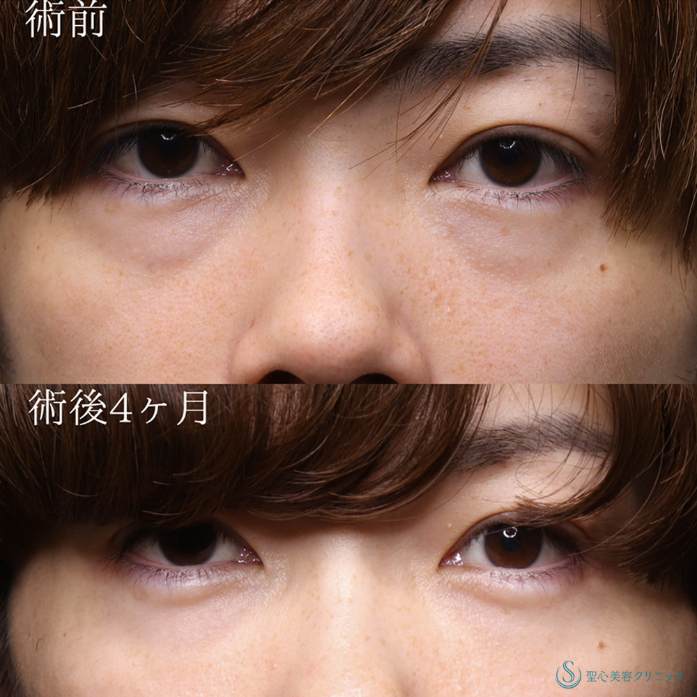 【30代男性・目の下のクマを撃退】プレミアムPRP皮膚再生療法（術後4ヶ月） Before 