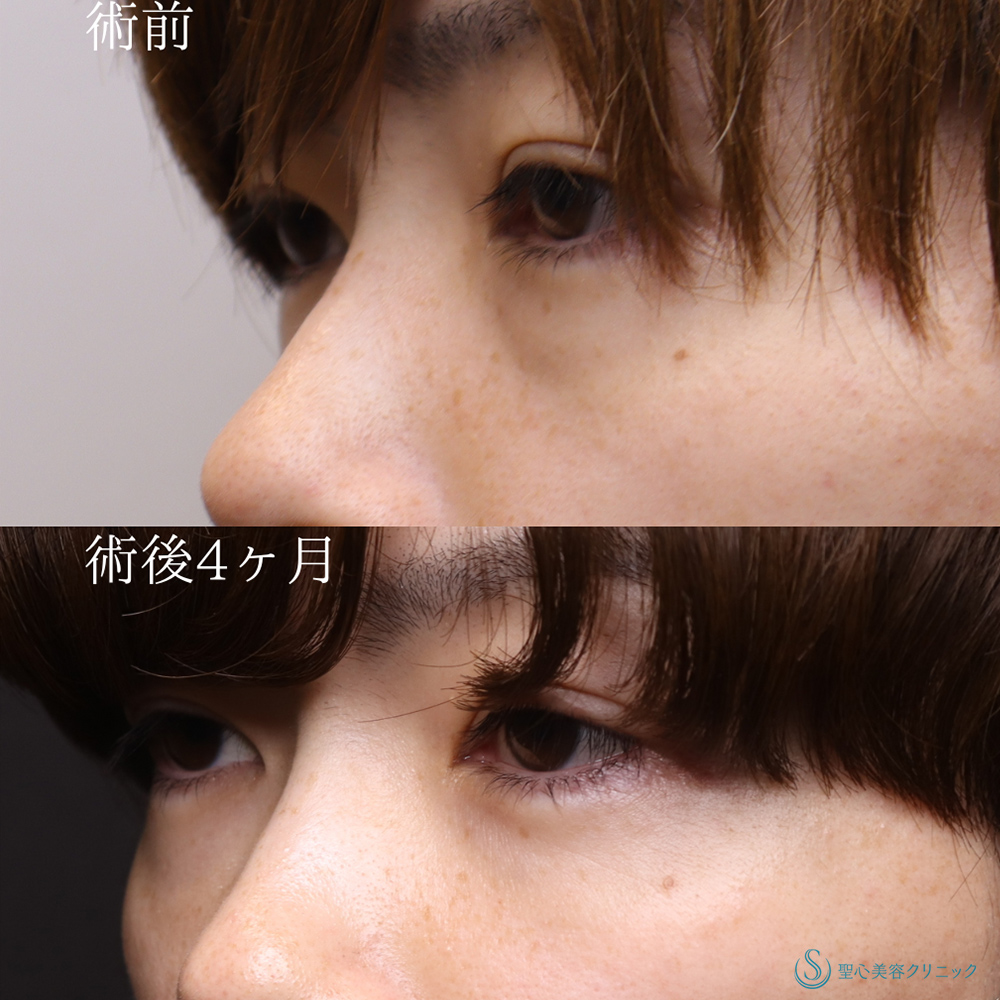 【30代男性・目の下のクマを撃退】プレミアムPRP皮膚再生療法（術後4ヶ月） After 