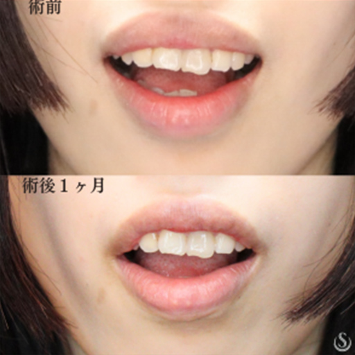 【20代女性・唇を薄く】上口唇縮小術（術後1ヶ月） Before 