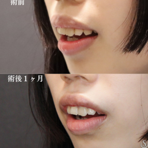 【20代女性・唇を薄く】上口唇縮小術（術後1ヶ月） After 
