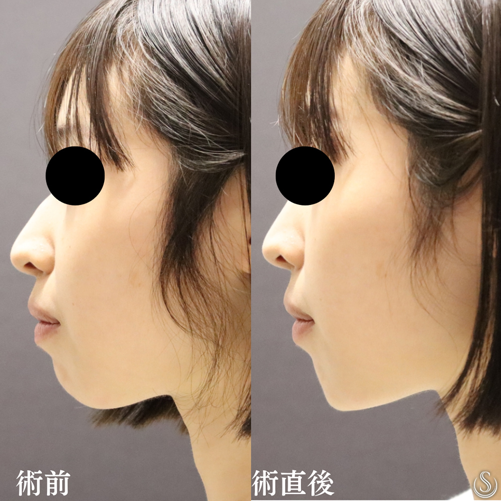 【20代女性・顎の形を整えよりシャープに】顎のヒアルロン酸（直後） Before 