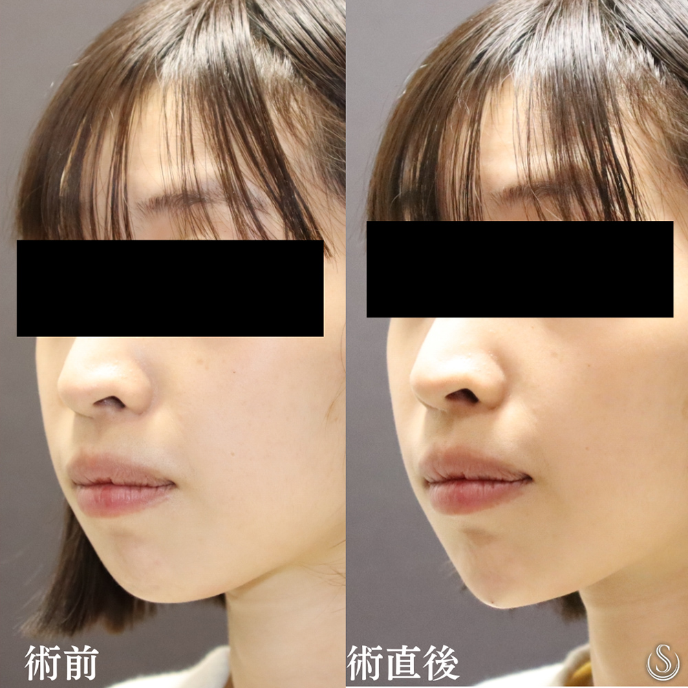 【20代女性・顎の形を整えよりシャープに】顎のヒアルロン酸（直後） After 