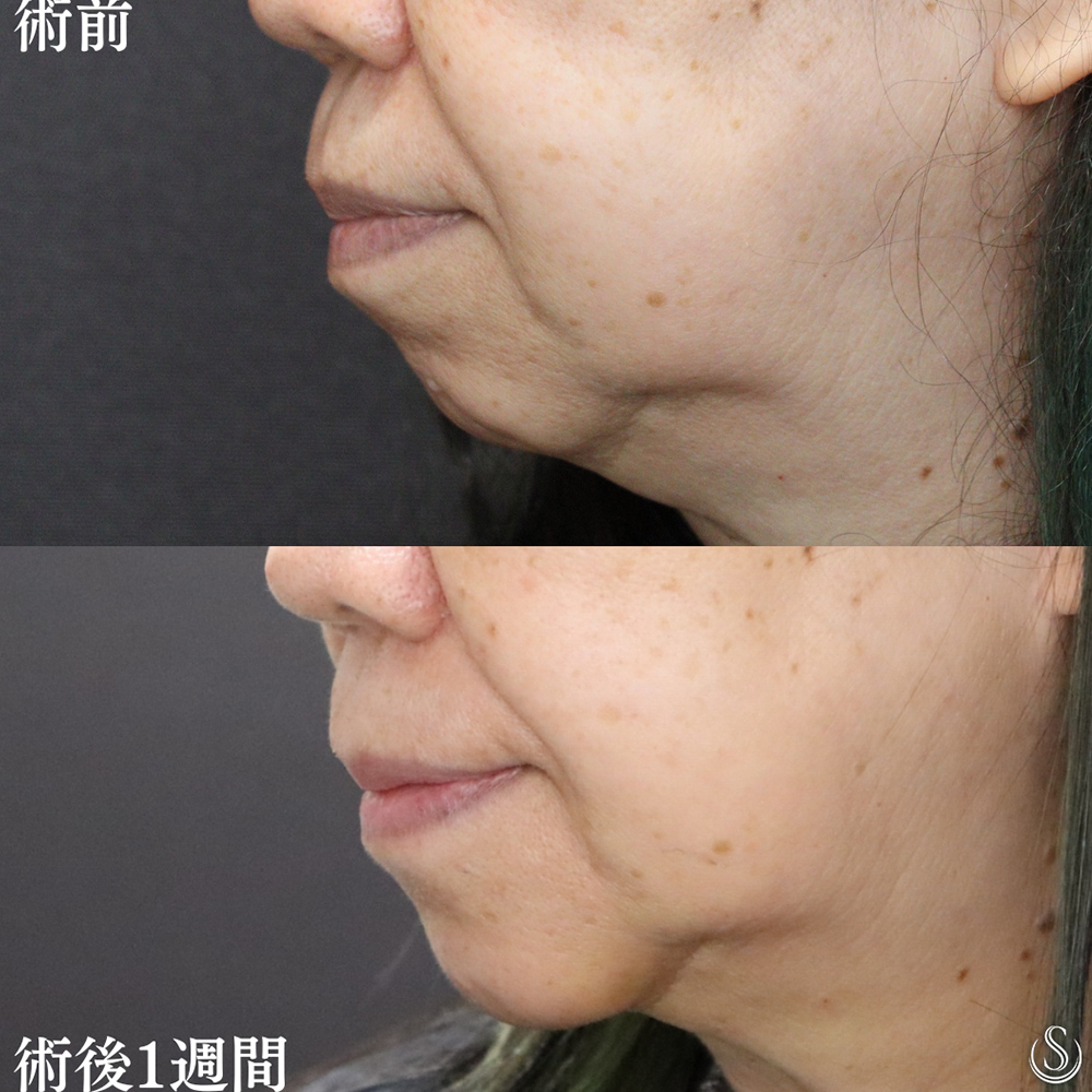 【60代女性・顎を整え前進】あごプロテーゼ（術後1週間） Before 