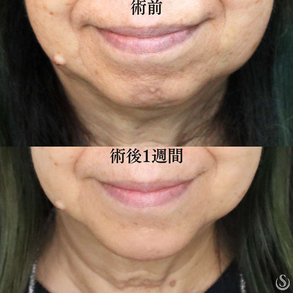 【60代女性・顎を整え前進】あごプロテーゼ（術後1週間） After 