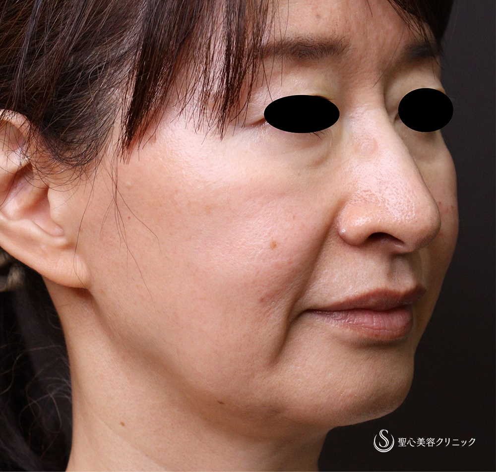 【50代女性・目の下のくま、ほうれい線、マリオネットライン】プレミアムPRP皮膚再生療法 Before 
