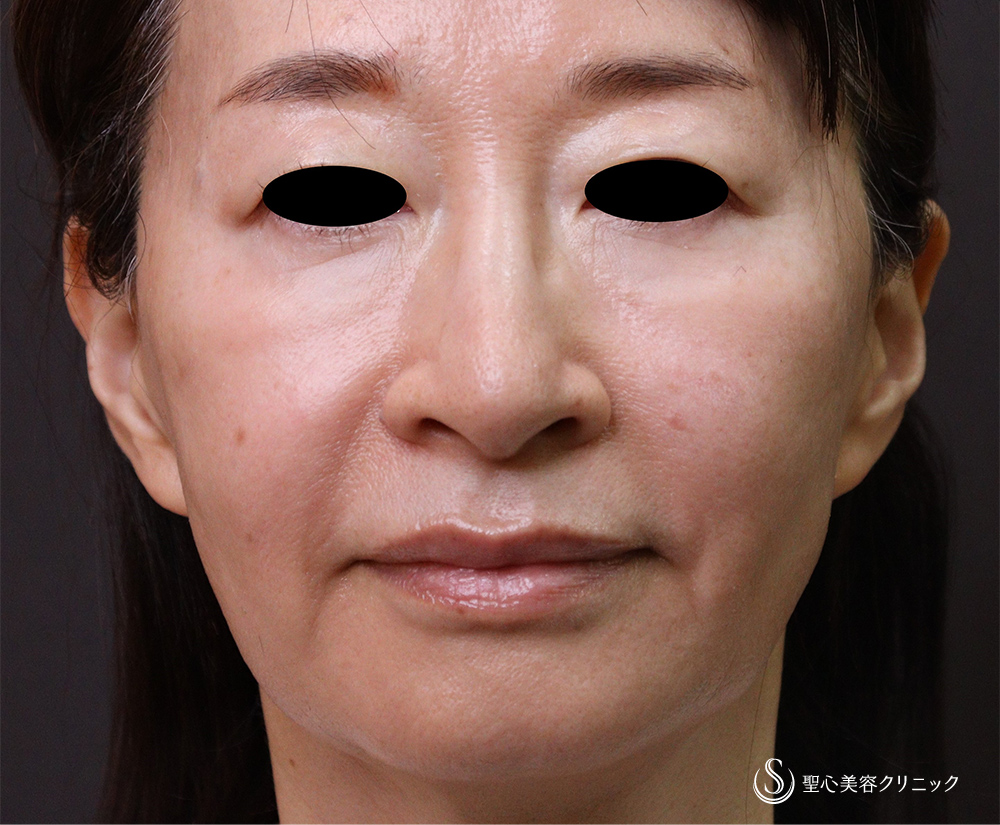 【50代女性・目の下のくま、ほうれい線、マリオネットライン】プレミアムPRP皮膚再生療法 After 