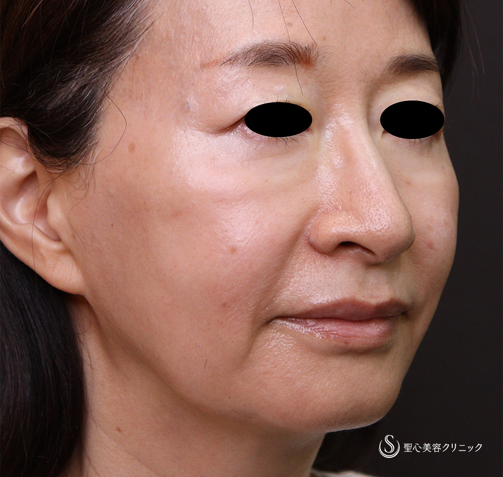 【50代女性・目の下のくま、ほうれい線、マリオネットライン】プレミアムPRP皮膚再生療法 After 
