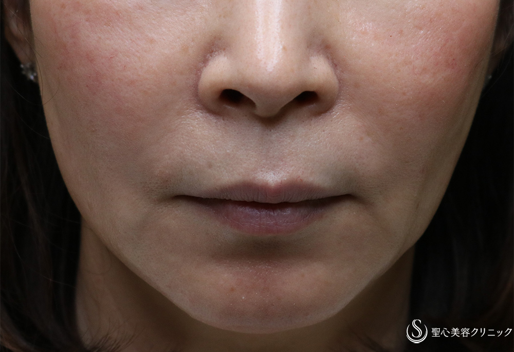 【50代女性・ほうれい線、マリオネットラインの若返り】プレミアムPRP皮膚再生療法（1年8ヶ月後） After 