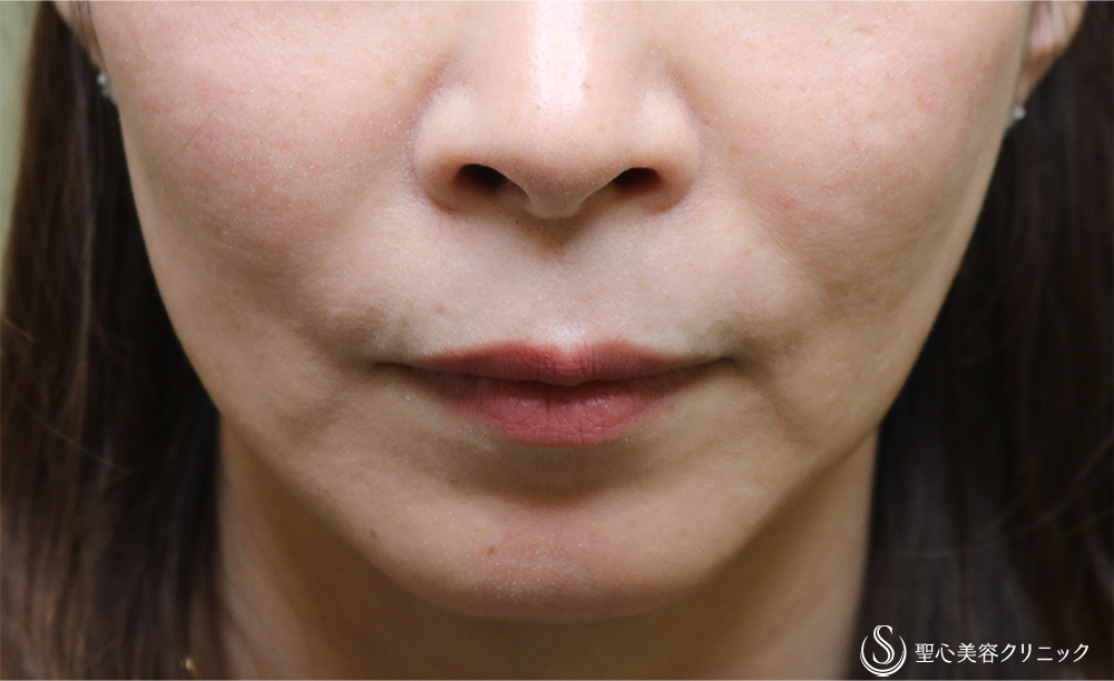 【50代女性・ほうれい線、マリオネットラインの若返り】プレミアムPRP皮膚再生療法（1年8ヶ月後） Before 