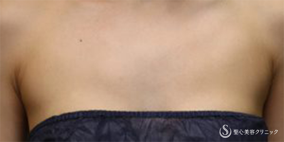 【30代女性・デコルテを綺麗に】プレミアムPRP皮膚再生療法(デコルテ)(術後6ヶ月・追加後1ヶ月) After 