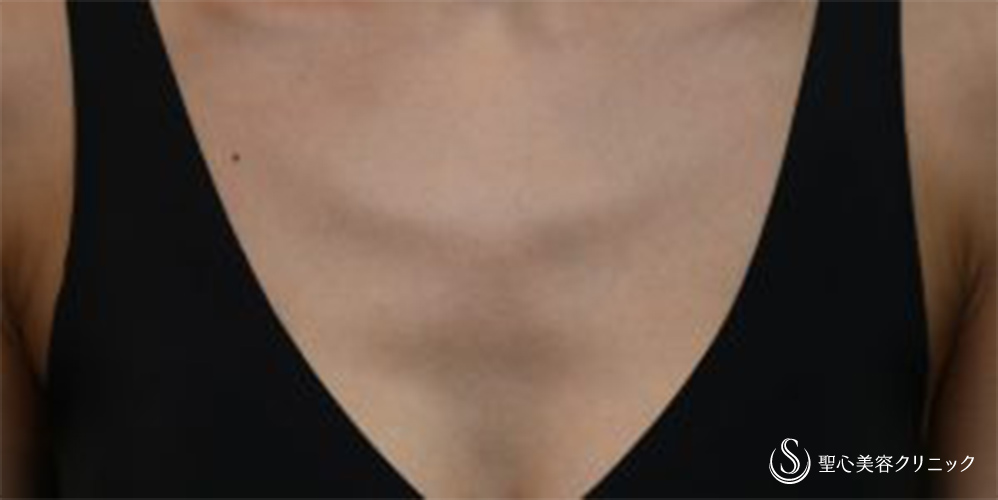 【30代女性・デコルテを綺麗に】プレミアムPRP皮膚再生療法(デコルテ)(術後6ヶ月・追加後1ヶ月) Before 