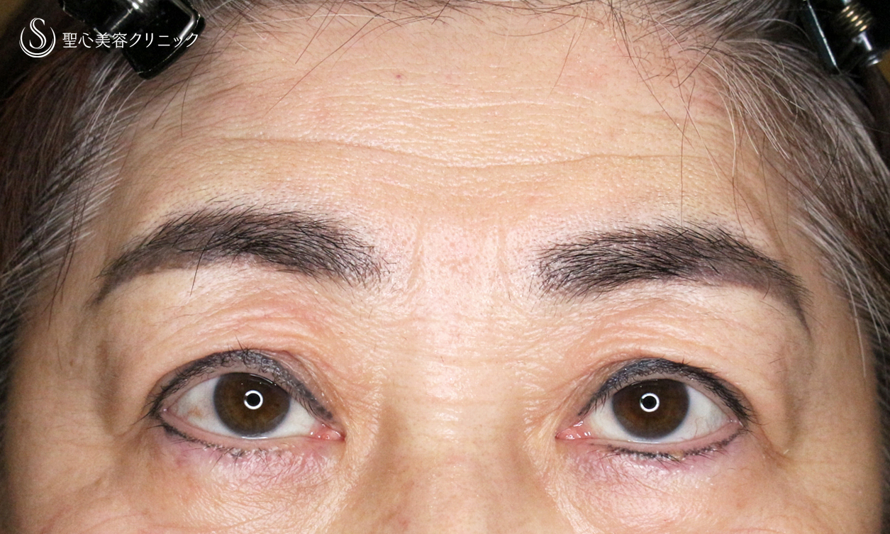 【70代女性・ハードコンタクトによる眼瞼下垂】切らない眼瞼下垂+α法 単独（術直後〜4ヶ月後） After 