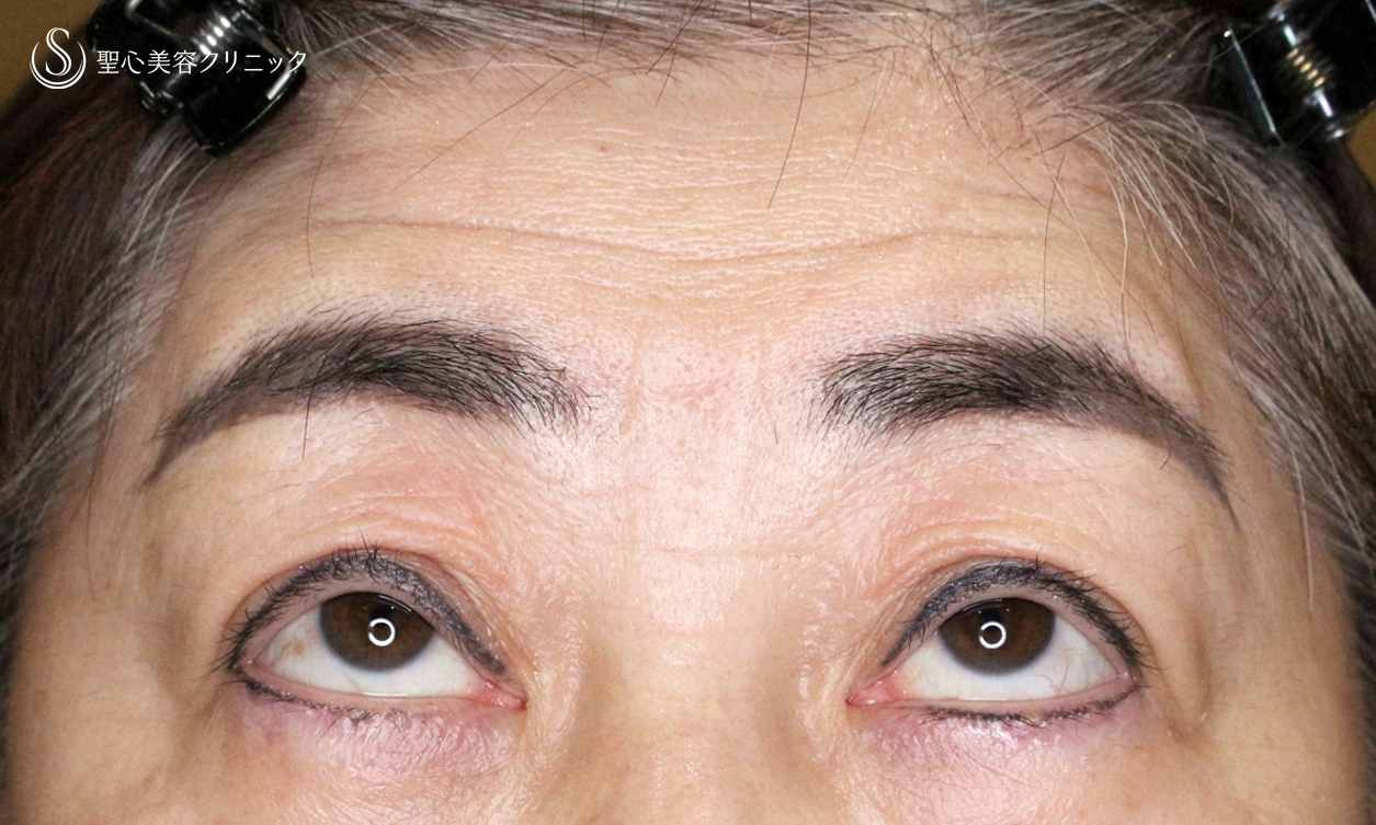 【70代女性・ハードコンタクトによる眼瞼下垂】切らない眼瞼下垂+α法 単独（術直後〜4ヶ月後） After 