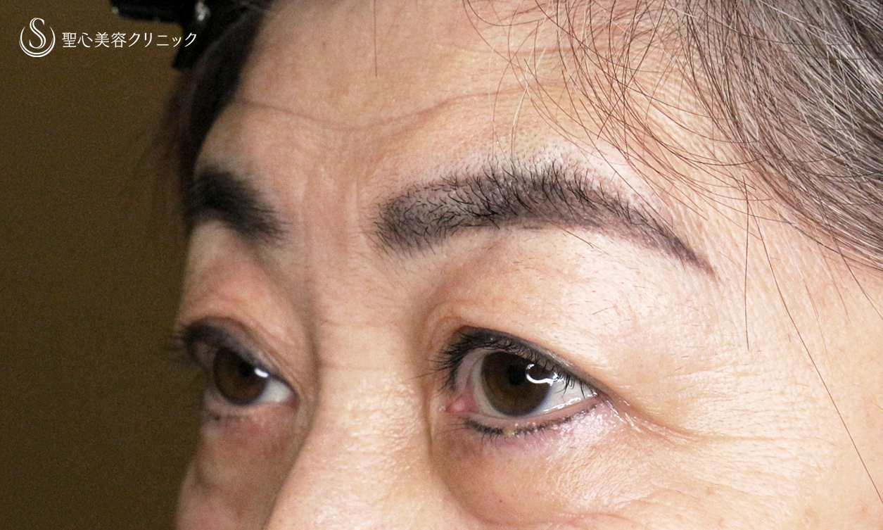 【70代女性・ハードコンタクトによる眼瞼下垂】切らない眼瞼下垂+α法 単独（術直後〜4ヶ月後） After 