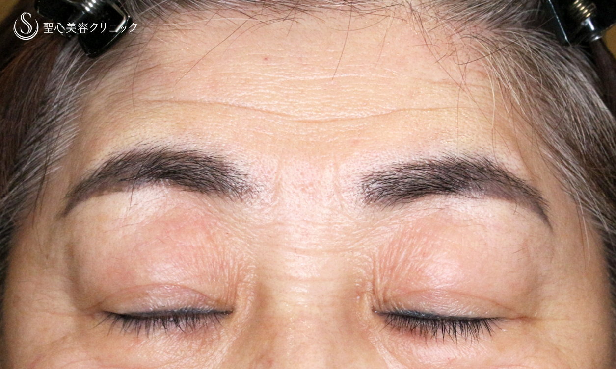 【70代女性・ハードコンタクトによる眼瞼下垂】切らない眼瞼下垂+α法 単独（術直後〜4ヶ月後） After 