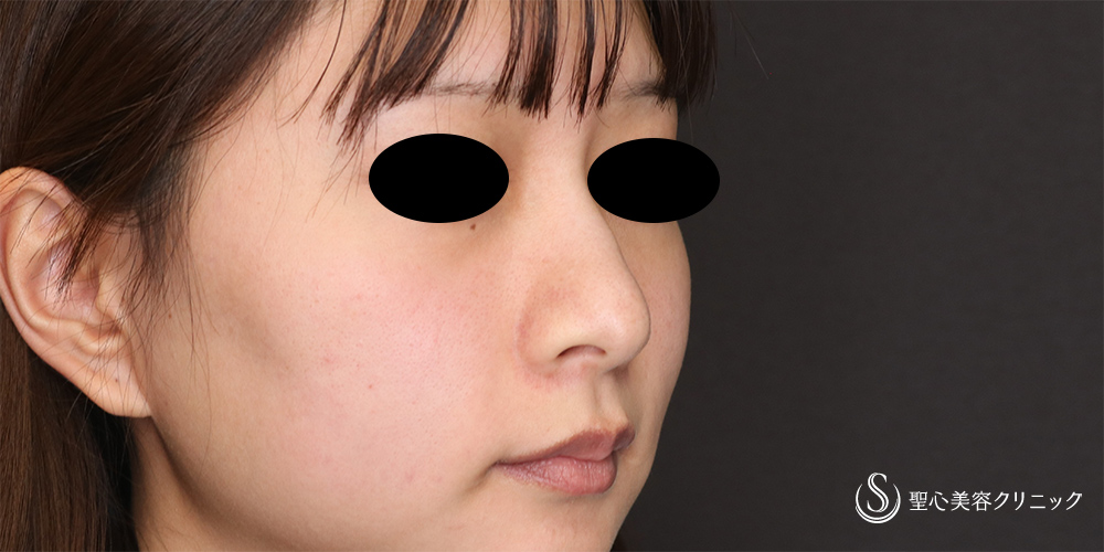 【20代女性・鼻先をスッキリ】鼻尖縮小(オープン法)＋耳介軟骨移植(2か月後) Before 