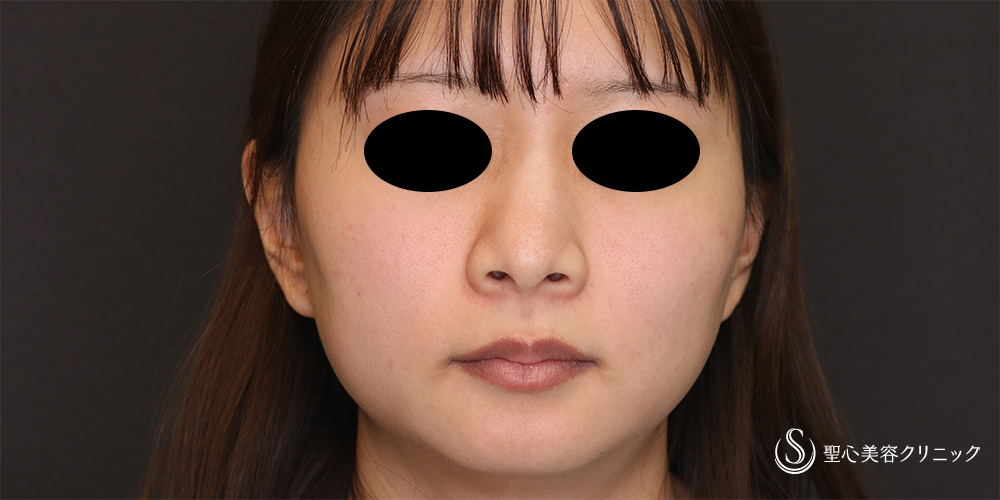【20代女性・鼻先をスッキリ】鼻尖縮小(オープン法)＋耳介軟骨移植(2か月後) Before 