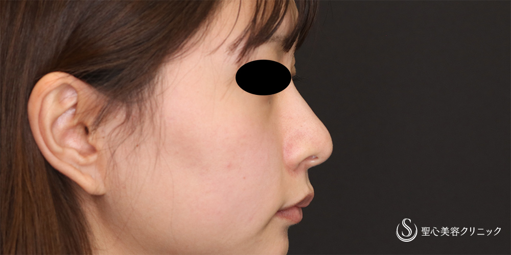 【20代女性・鼻先をスッキリ】鼻尖縮小(オープン法)＋耳介軟骨移植(2か月後) Before 