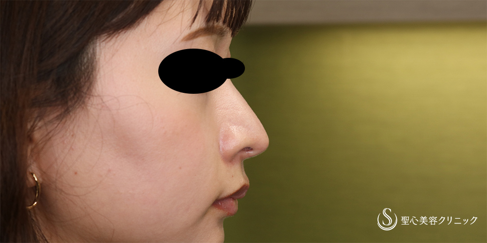 【20代女性・鼻先をスッキリ】鼻尖縮小(オープン法)＋耳介軟骨移植(2か月後) After 
