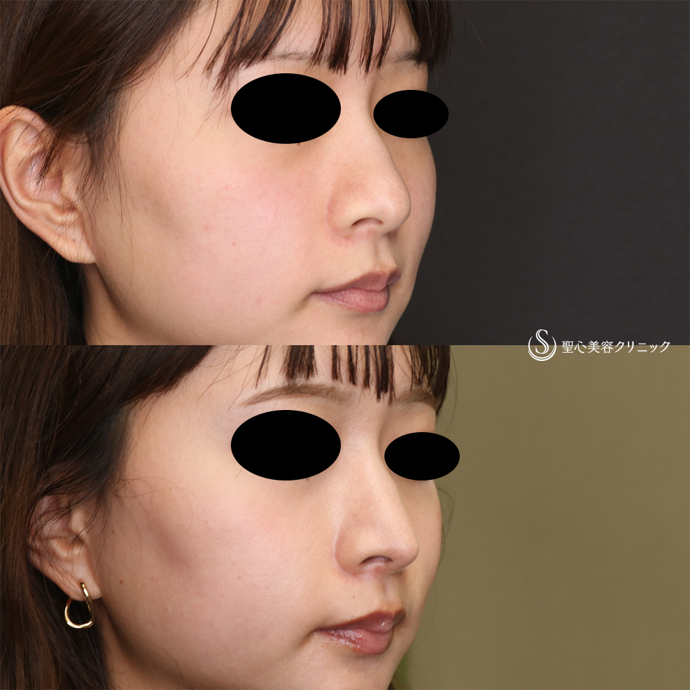 【20代女性・鼻先をスッキリ】鼻尖縮小(オープン法)＋耳介軟骨移植(2か月後) After 
