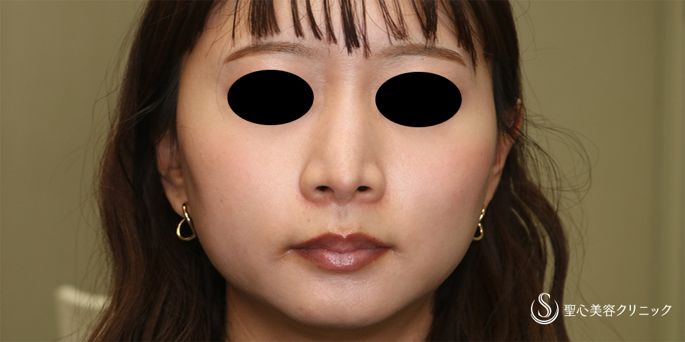 【20代女性・鼻先をスッキリ】鼻尖縮小(オープン法)＋耳介軟骨移植(2か月後) After 