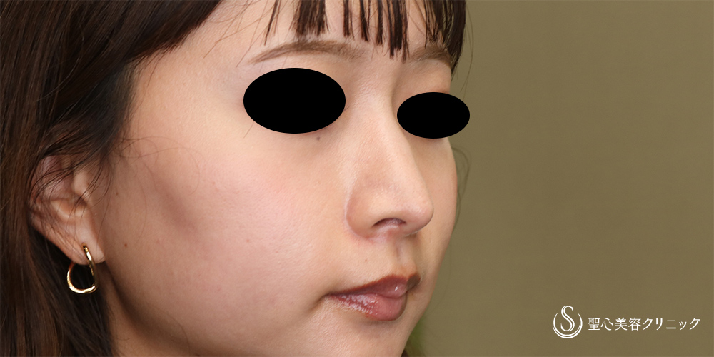 【20代女性・鼻先をスッキリ】鼻尖縮小(オープン法)＋耳介軟骨移植(2か月後) After 