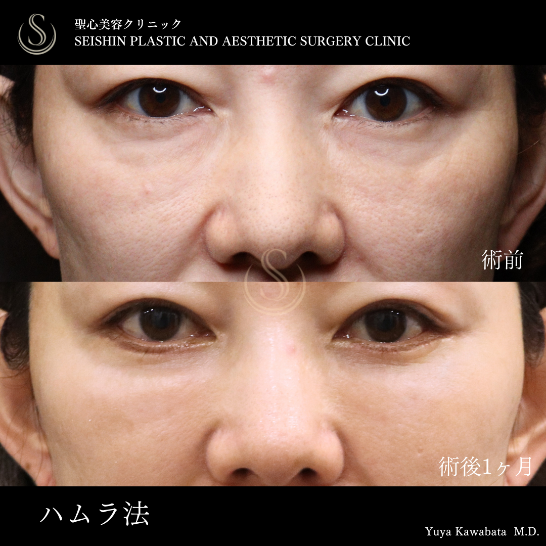 【40代女性・ハムラ法で目の下のクマをスッキリ】下眼瞼切開術/下眼瞼除皺術/ハムラ法（1ヶ月後） Before 