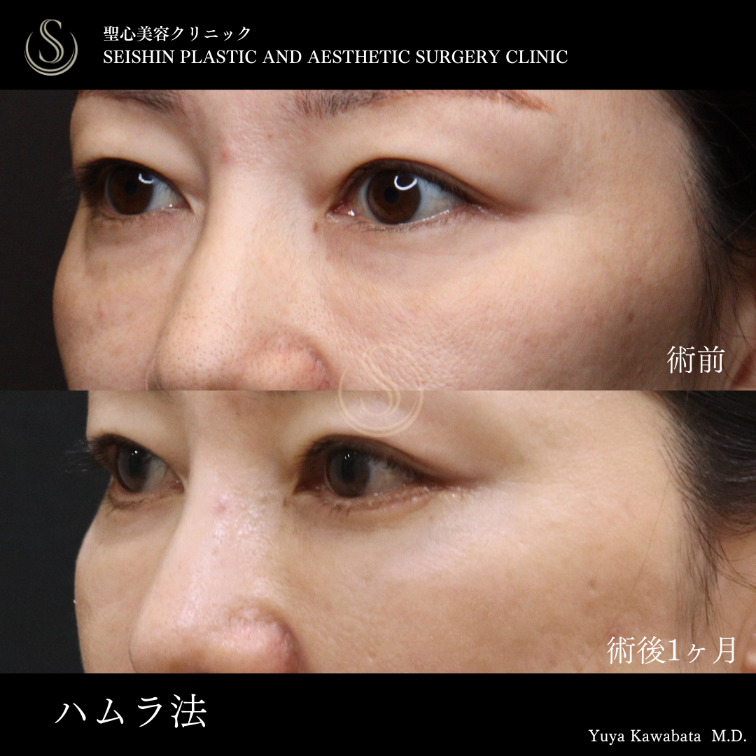 【40代女性・ハムラ法で目の下のクマをスッキリ】下眼瞼切開術/下眼瞼除皺術/ハムラ法（1ヶ月後） After 
