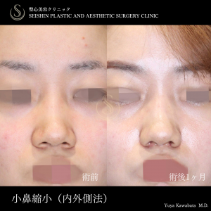 【20代女性・小鼻縮小でお鼻をスッキリ】小鼻縮小（内側法＋外側法） Before 