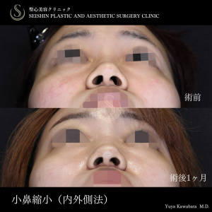 【20代女性・小鼻縮小でお鼻をスッキリ】小鼻縮小（内側法＋外側法） After 