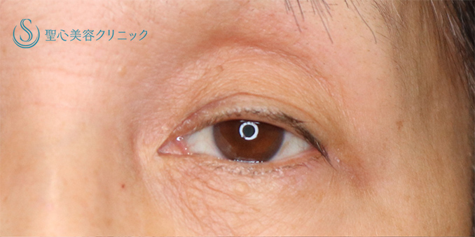 【60代女性・目の開きを改善】眼瞼下垂（埋没法）（術後2年） Before 