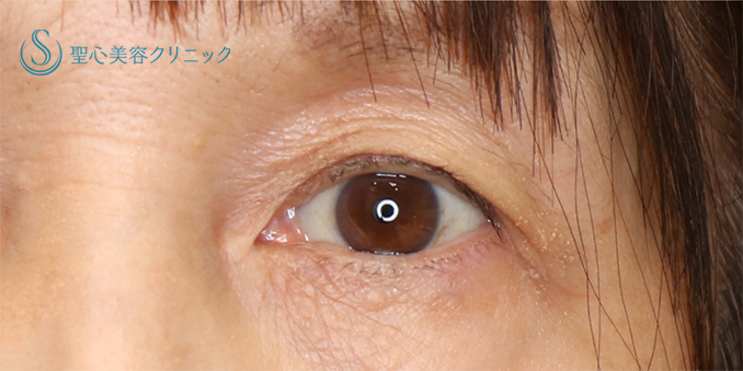 【60代女性・目の開きを改善】眼瞼下垂（埋没法）（術後2年） After 