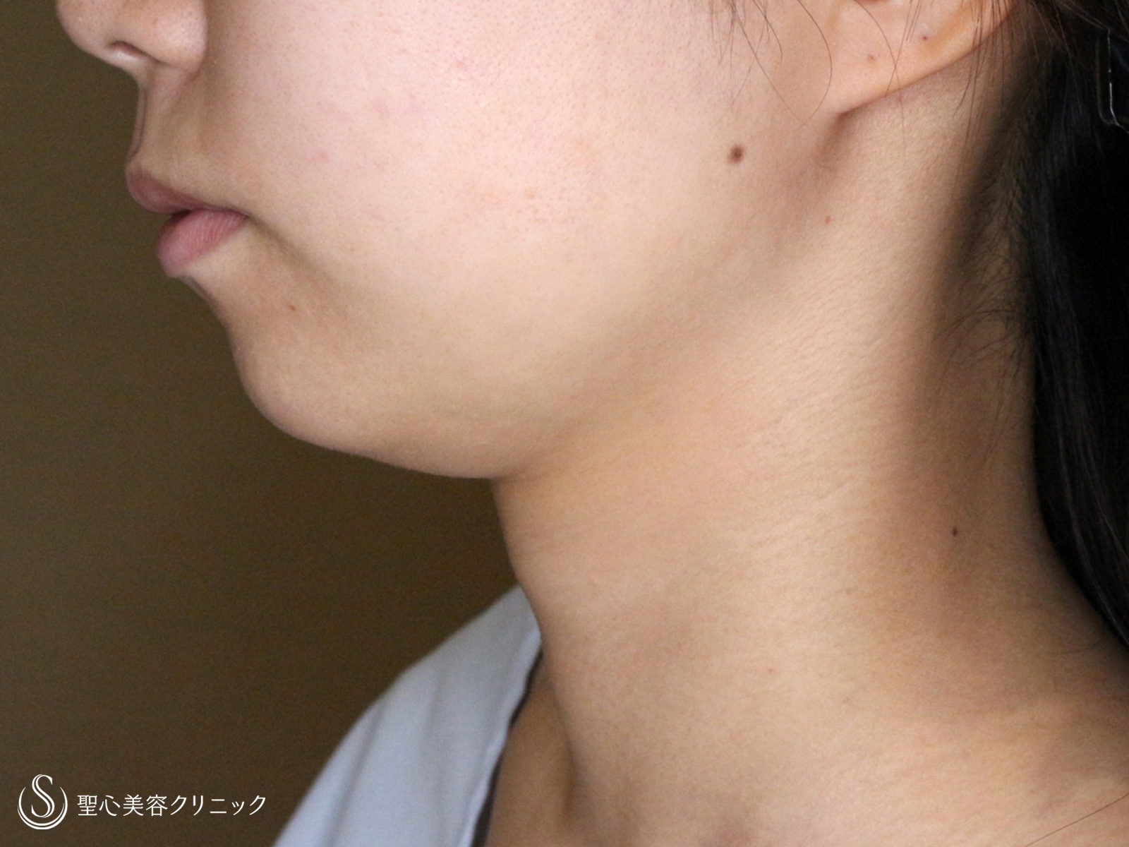 【20台女性・抜群の小顔効果】脂肪吸引注射「あご下」（術直後〜1年5ヶ月後） Before 