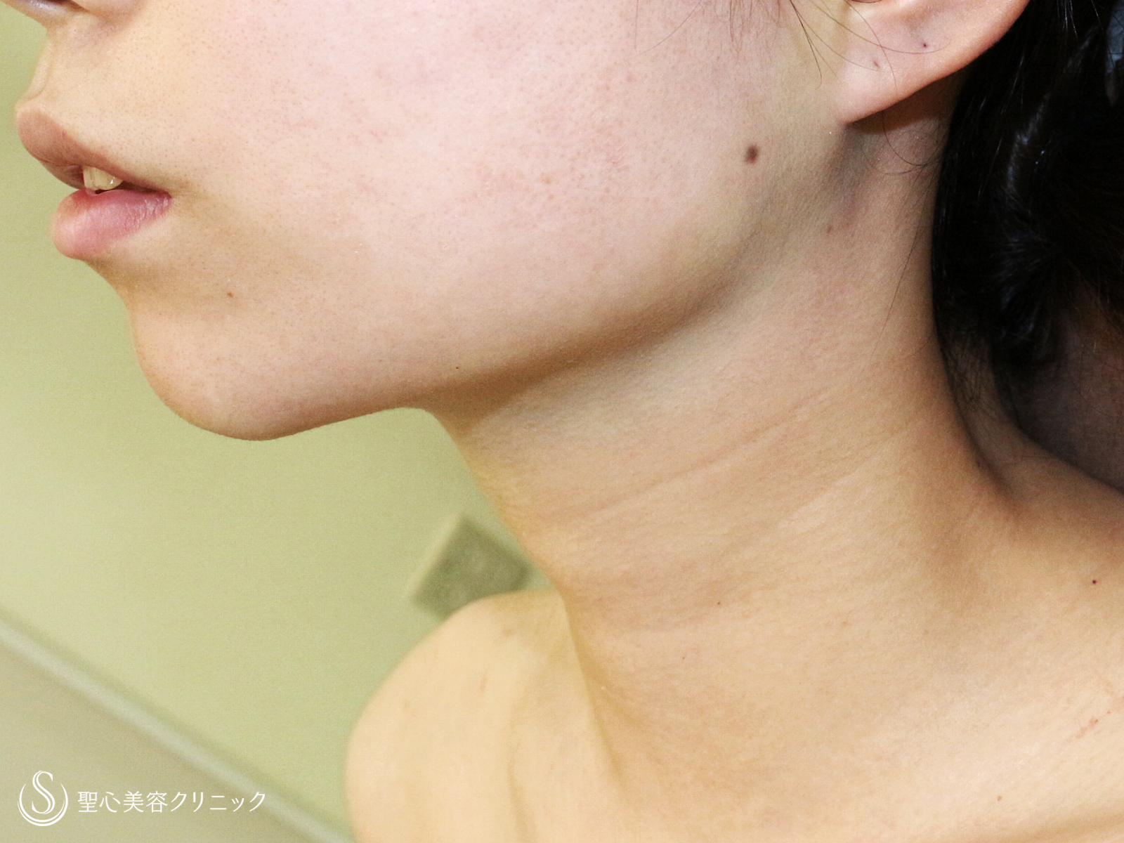 【20台女性・抜群の小顔効果】脂肪吸引注射「あご下」（術直後〜1年5ヶ月後） Before 