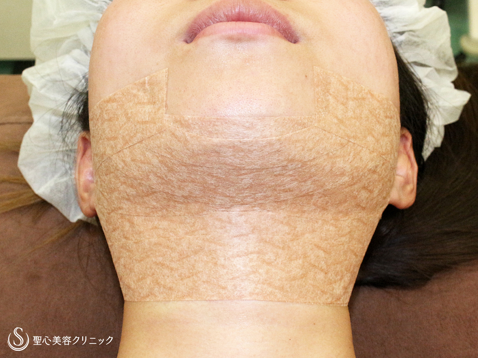 【20台女性・抜群の小顔効果】脂肪吸引注射「あご下」（術直後〜1年5ヶ月後） Before 