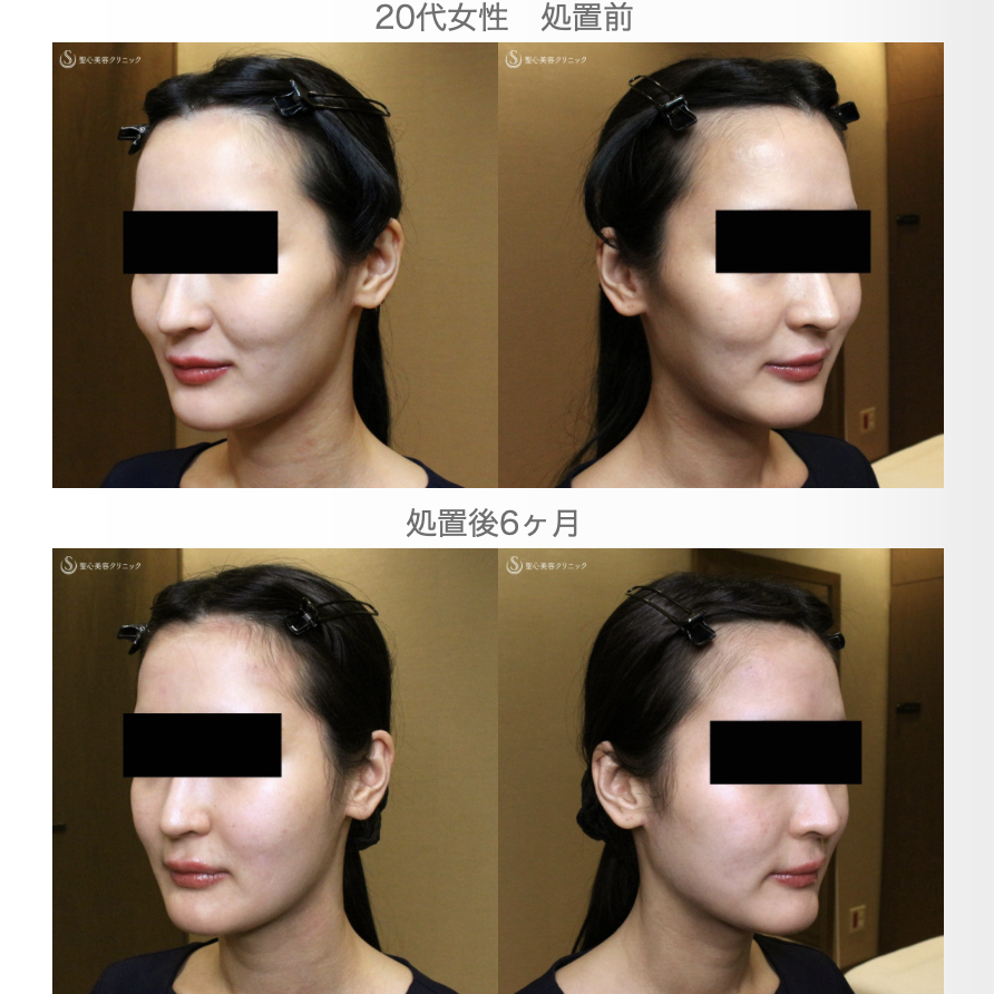 【20代女性・貴族注射＆ホホの凹み治療】プレミアムPRP皮膚再生療法（翌日〜6ヶ月後） After 
