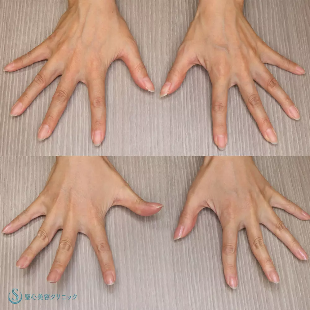 【40代女性・手の甲を綺麗に】プレミアムPRP皮膚再生療法(手の甲)(5ヶ月後) After 
