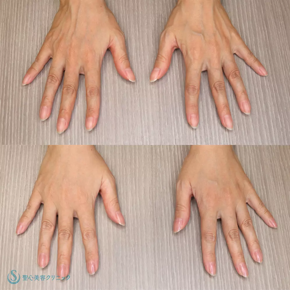 【40代女性・手の甲を綺麗に】プレミアムPRP皮膚再生療法(手の甲)(5ヶ月後) After 