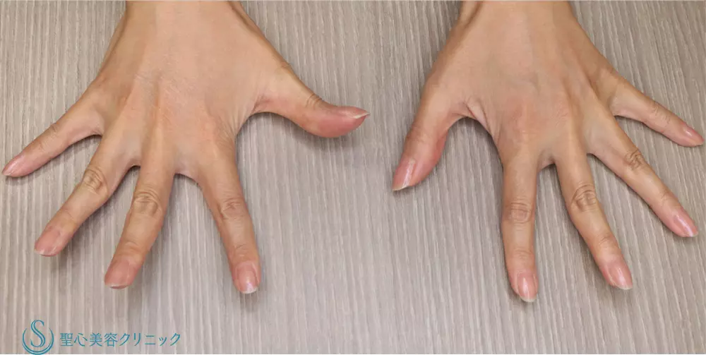 【40代女性・手の甲を綺麗に】プレミアムPRP皮膚再生療法(手の甲)(5ヶ月後) After 