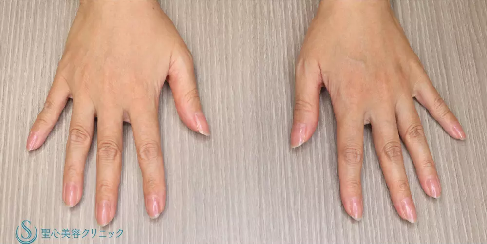 【40代女性・手の甲を綺麗に】プレミアムPRP皮膚再生療法(手の甲)(5ヶ月後) After 