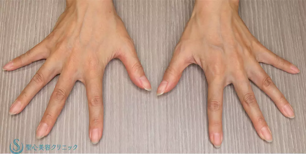 【40代女性・手の甲を綺麗に】プレミアムPRP皮膚再生療法(手の甲)(5ヶ月後) Before 