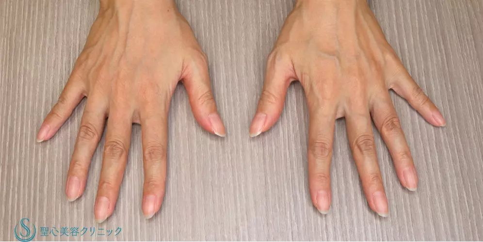 【40代女性・手の甲を綺麗に】プレミアムPRP皮膚再生療法(手の甲)(5ヶ月後) Before 